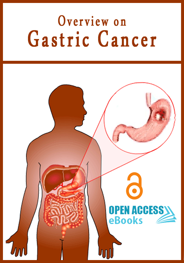 overview-on-gastric-cancer