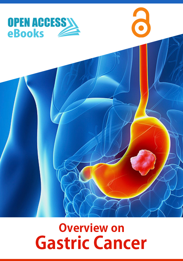 overview-on-gastric-cancer